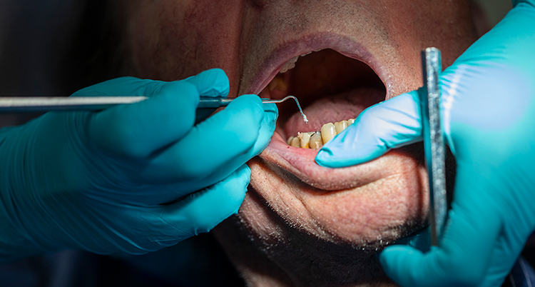 En person med öppen mun får tandvård. En tandläkare med handskar jobbar med en sond mot tanden.