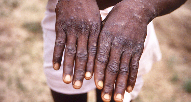 Congo Mpox Outbreak