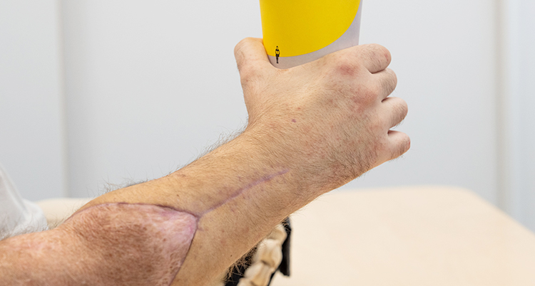 En hand som håller i en mugg. På armen syns märken från en operation.